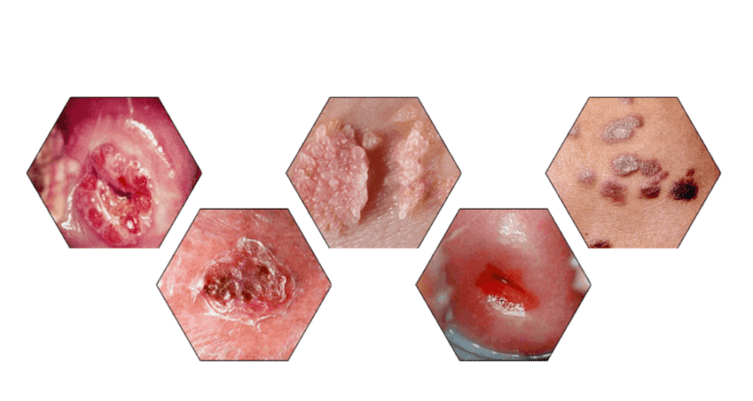 Γιατί είναι επικίνδυνα τα θηλώματα;