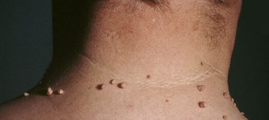 πώς να απαλλαγείτε από τα θηλώματα