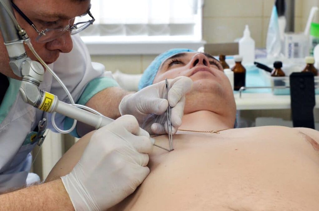 πώς να απαλλαγείτε από τα κονδυλώματα στο σώμα